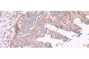 Immunohistochemistry of paraffin-embedded Human colorectal cancer tissue using ZSWIM1 Polyclonal Antibody at dilution of 1:55(x200)