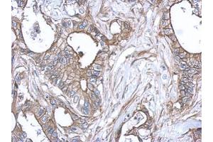 IHC-P Image Immunohistochemical analysis of paraffin-embedded human gastric cancer, using S100A10, antibody at 1:500 dilution.