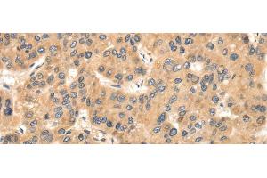 Immunohistochemistry of paraffin-embedded Human liver cancer using TTC23 Polyclonal Antibody at dilution of 1/35