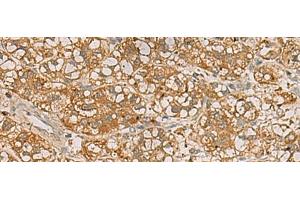 Immunohistochemistry of paraffin-embedded Human liver cancer tissue using QDPR Polyclonal Antibody at dilution of 1:70(x200)