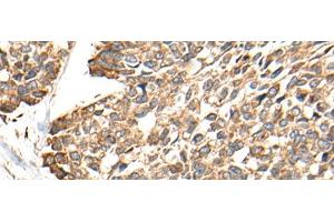 Immunohistochemistry of paraffin-embedded Human esophagus cancer tissue using RCAN3 Polyclonal Antibody at dilution of 1:60(x200)