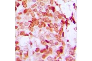 Immunohistochemical analysis of DAXX (pS668) staining in human breast cancer formalin fixed paraffin embedded tissue section.