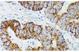 Immunohistochemistry of paraffin-embedded Human colon carcinoma using ETHE1 Polyclonal Antibody at dilution of 1:100 (40x lens).