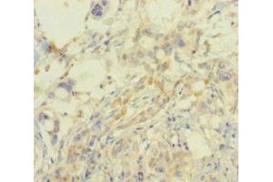 Immunohistochemistry of paraffin-embedded human pancreatic cancer using ABIN7164521 at dilution of 1:100