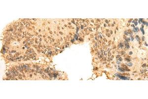 Immunohistochemistry of paraffin-embedded Human colorectal cancer tissue using CEP57 Polyclonal Antibody at dilution of 1:30(x200)