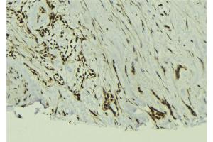 ABIN6273019 at 1/100 staining Human breast cancer tissue by IHC-P.