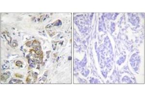 Immunohistochemistry analysis of paraffin-embedded human breast carcinoma, using ITGB4 (Phospho-Tyr1510) Antibody.