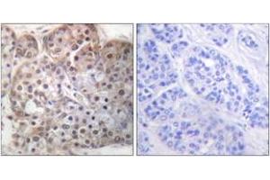 Immunohistochemistry analysis of paraffin-embedded human breast carcinoma, using STAT5A/B (Phospho-Ser725/730) Antibody.