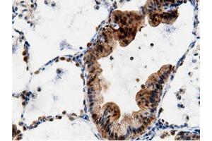 Immunohistochemical staining of paraffin-embedded Adenocarcinoma of Human breast tissue using anti-AK5 mouse monoclonal antibody.