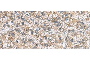Immunohistochemistry of paraffin-embedded Human liver cancer tissue using MRPL22 Polyclonal Antibody at dilution of 1:60(x200)