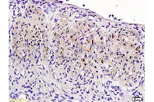 Formalin-fixed and paraffin embedded: rat uterine myoma labeled with Anti-PR (progesterone receptor) Polyclonal Antibody (ABIN725090), Unconjugated 1:200 followed by conjugation to the secondary antibody and DAB staining