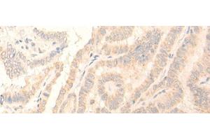 Immunohistochemistry of paraffin-embedded Human thyroid cancer tissue using ADGRE3 Polyclonal Antibody at dilution of 1:35(x200)