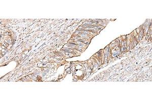 Immunohistochemistry of paraffin-embedded Human colorectal cancer tissue using BLVRB Polyclonal Antibody at dilution of 1:65(x200)