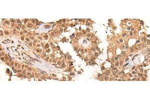 Immunohistochemistry of paraffin-embedded Human ovarian cancer tissue using CLK2 Polyclonal Antibody at dilution of 1:45(x200)