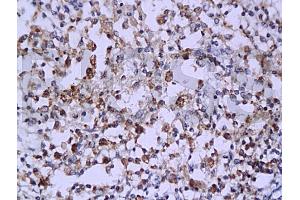Formalin-fixed and paraffin embedded: human endometrium carcinoma labeled with Anti-Caspase-6 Polyclonal Antibody (ABIN725525), Unconjugated 1:200 followed by conjugation to the secondary antibody and DAB staining