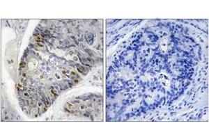 Immunohistochemistry analysis of paraffin-embedded human colon carcinoma, using Histone H1 (Phospho-Thr17) Antibody.