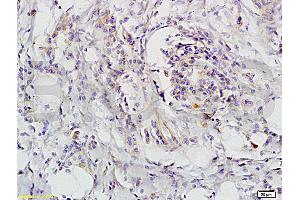 Formalin-fixed and paraffin-embedded human colon carcinoma labeled with Rabbit Anti-CD118 Polyclonal Antibody, unconjugated  (ABIN686827)  1: 200 followed by incubation with conjugated secondary antibody and DAB staining