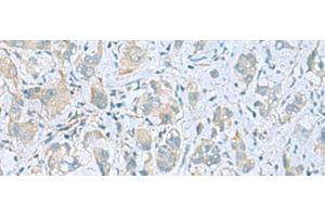Immunohistochemistry of paraffin-embedded Human liver cancer tissue using PLN Polyclonal Antibody at dilution of 1:45(x200)