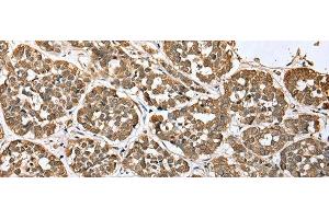 Immunohistochemistry of paraffin-embedded Human esophagus cancer tissue using ATXN7L3 Polyclonal Antibody at dilution of 1:35(x200)