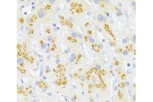 Immunohistochemistry of paraffin-embedded Human liver cancer using FAS Polyclonal Antibody at dilution of 1:100 (40x lens).