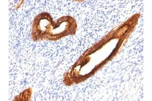 Formalin-fixed, paraffin-embedded human endometrial carcinoma stained with MUC-1 antibody.