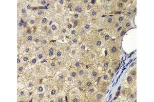 Immunohistochemistry of paraffin-embedded Human liver cancer using AP2A2 Polyclonal Antibody at dilution of 1:200 (40x lens).