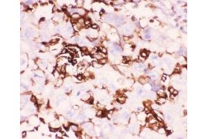 IHC-P: LFA-1 antibody testing of human lung cancer tissue