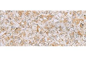 Immunohistochemistry of paraffin-embedded Human liver cancer tissue using FERMT1 Polyclonal Antibody at dilution of 1:30(x200)