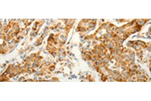 Immunohistochemistry of paraffin-embedded Human lung cancer tissue using VDAC2 Polyclonal Antibody at dilution of 1:25(x200)