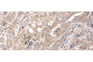 Immunohistochemistry of paraffin-embedded Human breast cancer tissue using PPBP Polyclonal Antibody at dilution of 1:35(x200)