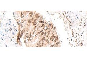 Immunohistochemistry of paraffin-embedded Human colorectal cancer tissue using CKMT1A/CKMT1B Polyclonal Antibody at dilution of 1:55(x200)