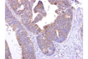 IHC-P Image GPR82 antibody [N2C1], Internal detects GPR82 protein at cytosol on human colon carcinoma by immunohistochemical analysis.