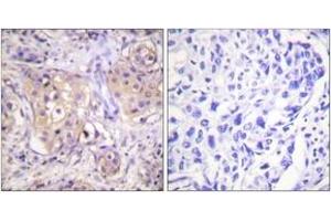 Immunohistochemistry analysis of paraffin-embedded human breast carcinoma, using PKC-pan (Phospho-Thr497) Antibody.