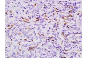 Formalin-fixed and paraffin embedded human cholangiocarcinoma tissue labeled with Anti-S100-A9 Polyclonal Antibody, Unconjugated  followed by conjugation to the secondary antibody and DAB staining.