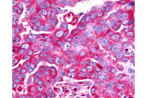 Anti-TAAR6 antibody IHC of human Ovary, Carcinoma.