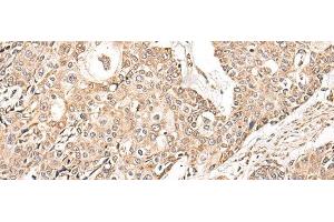 Immunohistochemistry of paraffin-embedded Human prost ate cancer tissue using NDUFB11 Polyclonal Antibody at dilution of 1:95(x200)