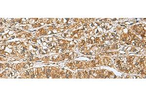 Immunohistochemistry of paraffin-embedded Human liver cancer tissue using GINS3 Polyclonal Antibody at dilution of 1:60(x200)