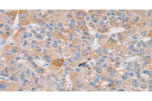 Immunohistochemistry of paraffin-embedded Human liver cancer using SLC25A13 Polyclonal Antibody at dilution of 1:35