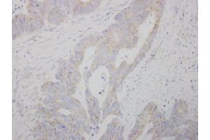 IHC-P Image COMT antibody detects COMT protein at cytosol on human colon carcinoma by immunohistochemical analysis.