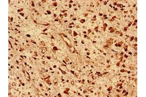Immunohistochemistry analysis of human glioma using ABIN7150524 at dilution of 1:100