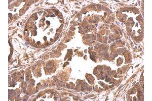 IHC-P Image EIF4A2 antibody detects EIF4A2 protein at cytosol on human ovarian carcinoma by immunohistochemical analysis.