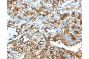 Formalin-fixed, paraffin-embedded human breast carcinoma stained with MUC-1 antibody.
