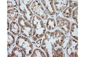 Immunohistochemical staining of paraffin-embedded Carcinoma of liver tissue using anti-RC203219 mouse monoclonal antibody.
