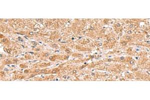 Immunohistochemistry of paraffin-embedded Human liver cancer tissue using HMGCLL1 Polyclonal Antibody at dilution of 1:70(x200)
