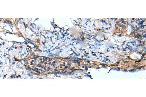 Immunohistochemistry of paraffin-embedded Human cervical cancer tissue using DEFB104A Polyclonal Antibody at dilution of 1:50(x200)