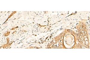 Immunohistochemistry of paraffin-embedded Human esophagus cancer tissue using EIF3C Polyclonal Antibody at dilution of 1:35(x200)