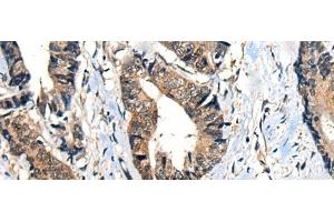 Immunohistochemistry of paraffin-embedded Human gastric cancer tissue using BMPER Polyclonal Antibody at dilution of 1:40(x200)