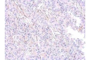 IHC-P Image MMP9 antibody [N2C1], Internal detects MMP9 protein at cytosol on AGS xenograft by immunohistochemical analysis.