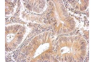 IHC-P Image RRM1 antibody detects RRM1 protein on human gastric cancer by immunohistochemical analysis.