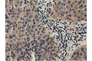Immunohistochemical staining of paraffin-embedded Carcinoma of Human bladder tissue using anti-CBWD1 mouse monoclonal antibody.